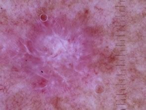 amelanotic melanoma dermoscopy